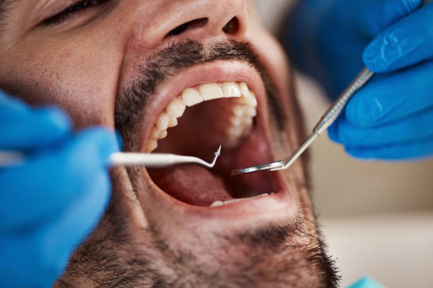 Best Emergency Treatment for Dental Infections or Abscesses in Addis, LA